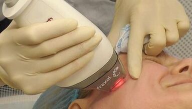 Kaip atliekamas frakcinis odos atjauninimas