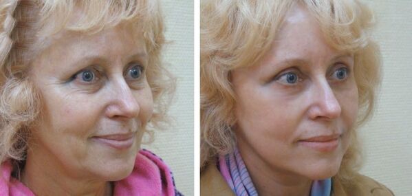 Moteris prieš ir po plazminio veido odos atjauninimo